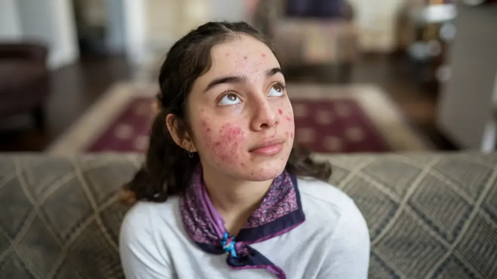 Acne: The Teenage Skin Battleground