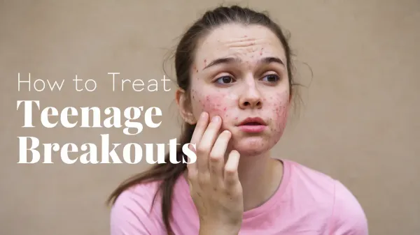 How to Treat Teenage Breakouts