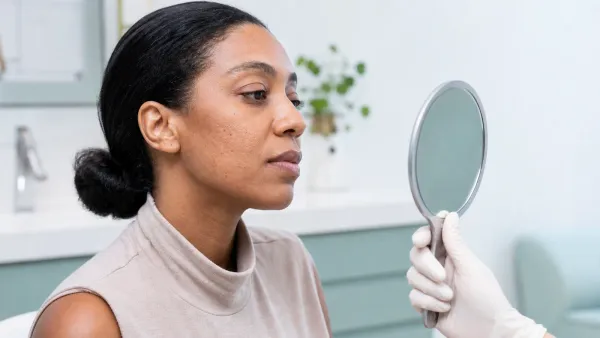 Dermatology consultation comparing depressed acne scars and flat post-acne marks in natural light